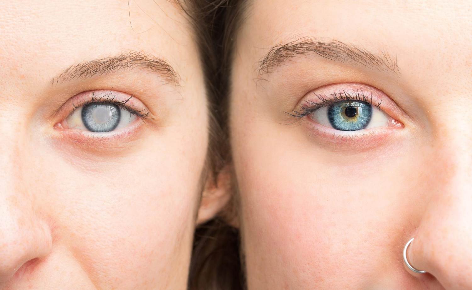 Glaucoma Treatment in Mumbai
