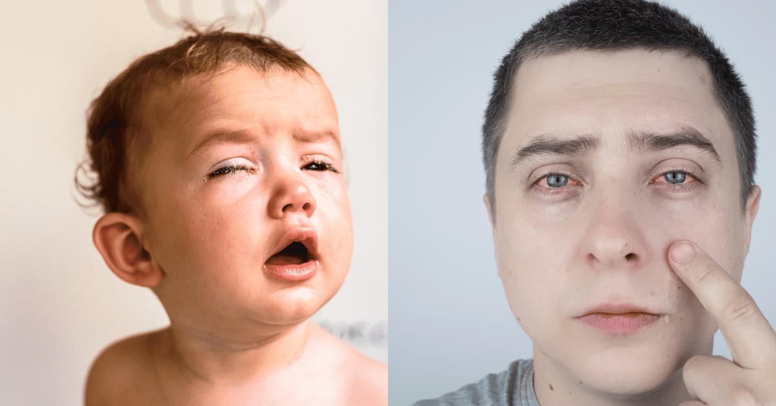 Blocked Tear duct treatment