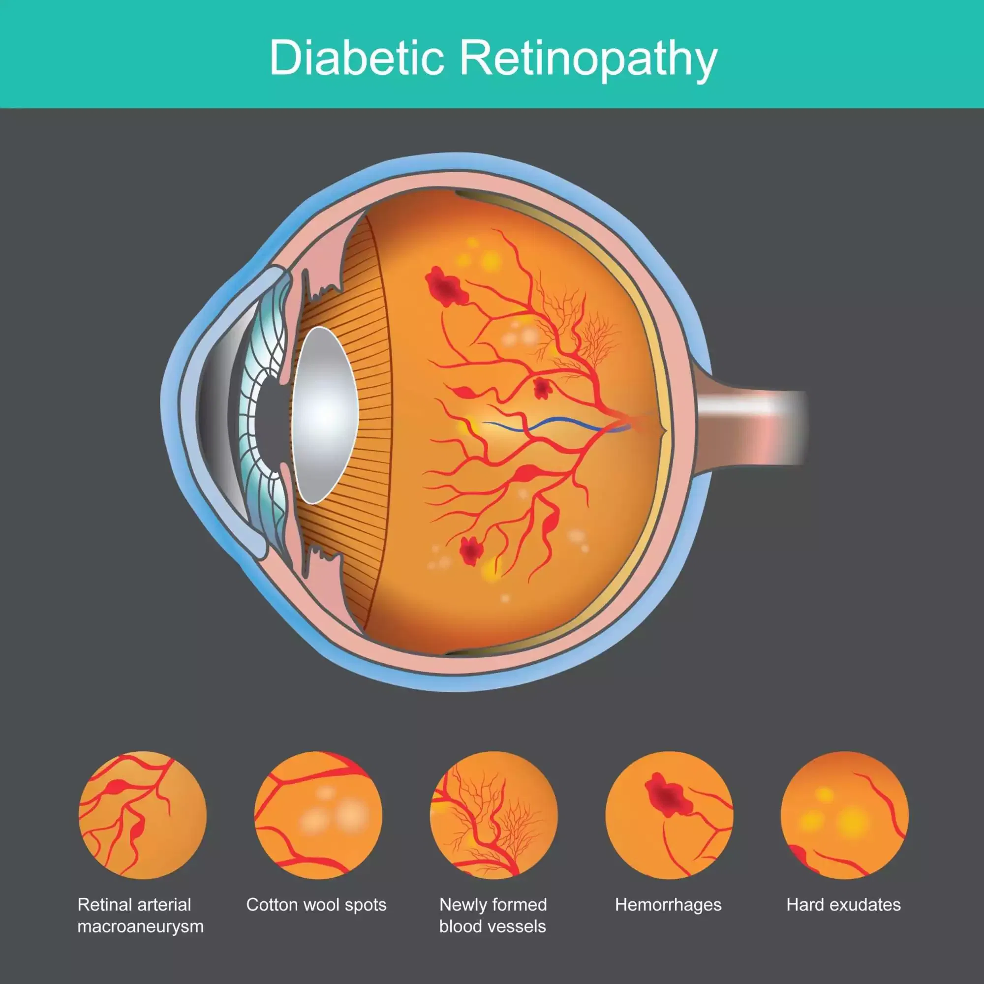 Diabetic Retinopathy specialist in Mumbai