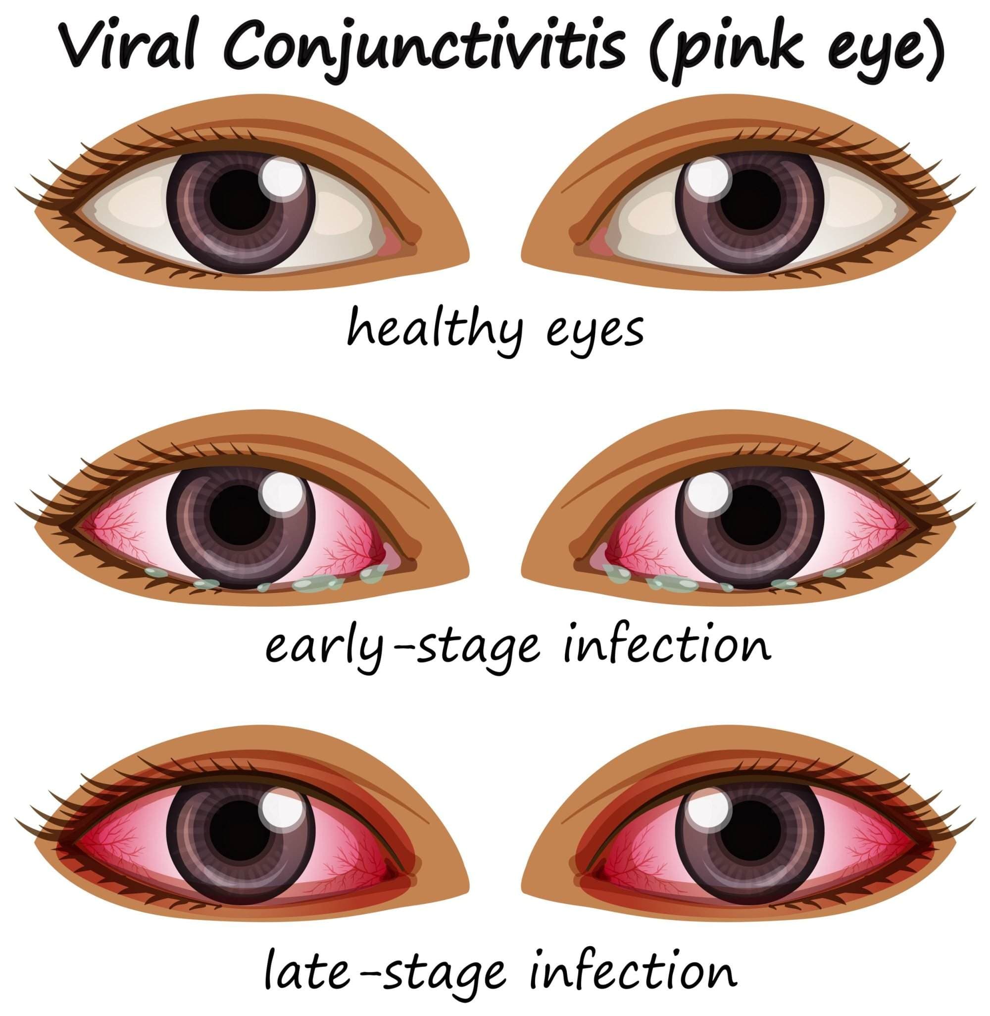 Eye Infection treatment in Mumbai