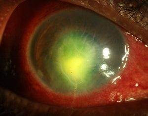 Eye Ulcer Image
