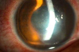 Eye Ulcer Treatment in Mumbai