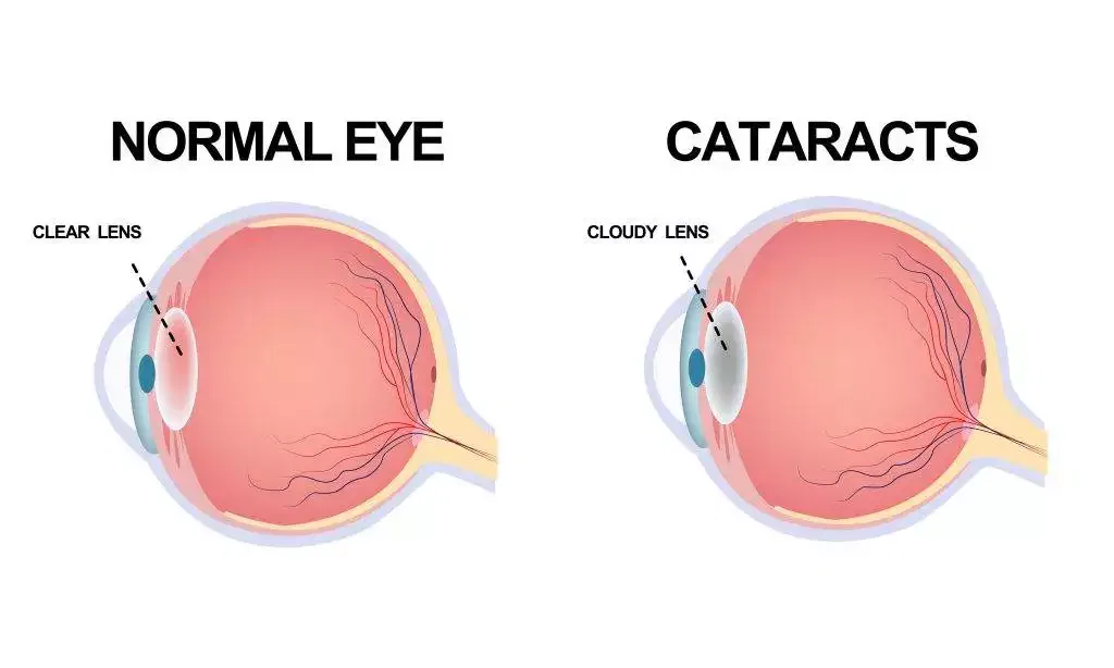Cataract surgery Mumbai