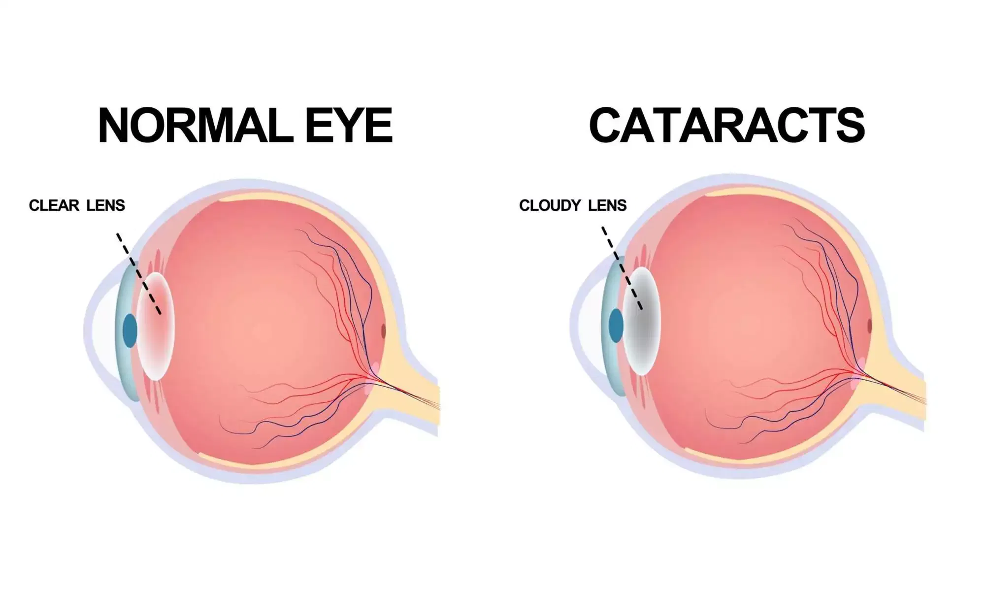 Cataract surgery Mumbai