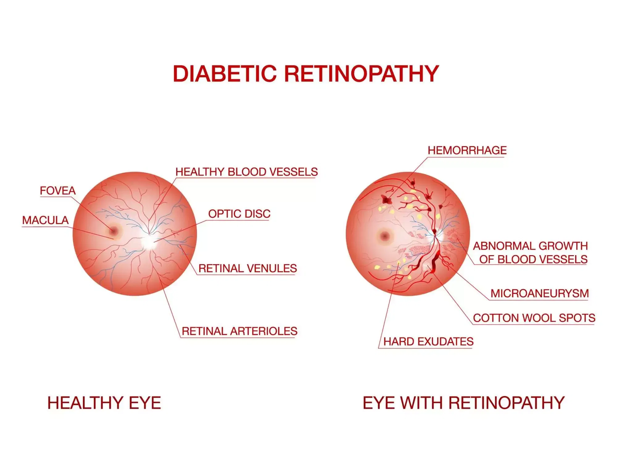 diabetic retinopathy treatment in Mumbai- Dr Anurag S Agarwal Eye Clinic