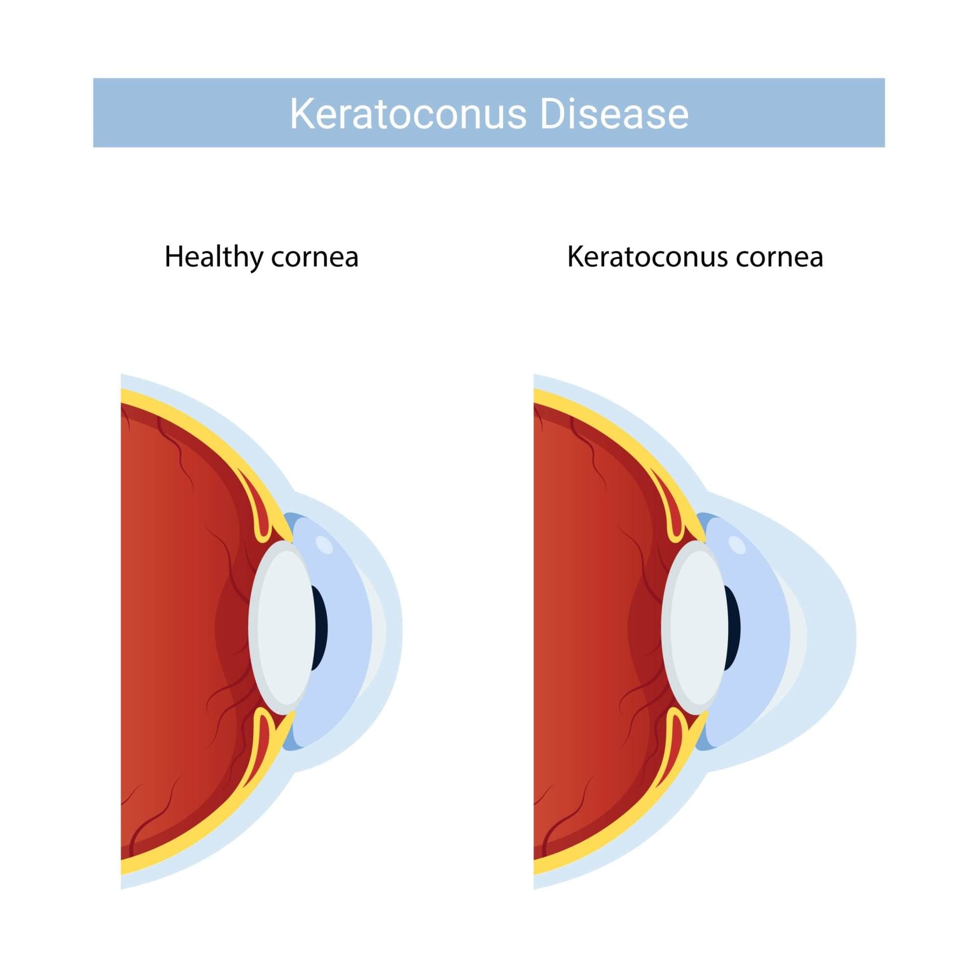 Cornea Specialist in Mumbai - Keratoconus treatment