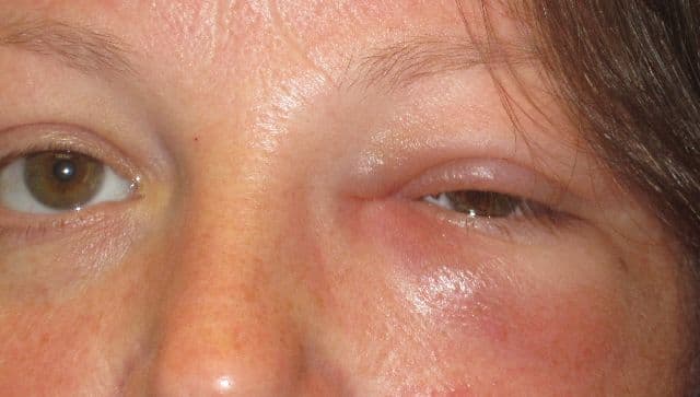 Acquired blocked tear duct in adult