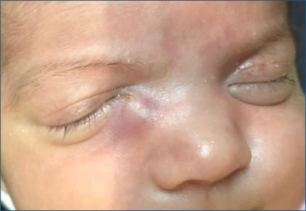 Congenital blocked tear duct
