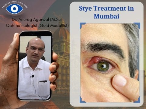 Stye treatment in Mumbai