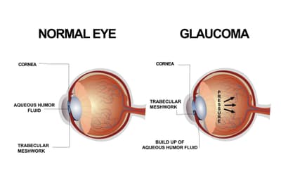 Glaucoma Treatment specialist in Mumbai