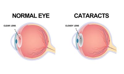 Cataract surgery Mumbai
