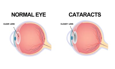 Cataract surgery Mumbai