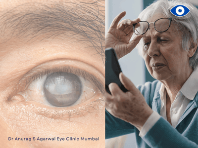 Diabetic Cataract Treatment