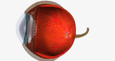 Ocular hypertension